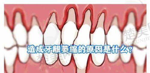 二、影响台州镶牙价格的核心因素
