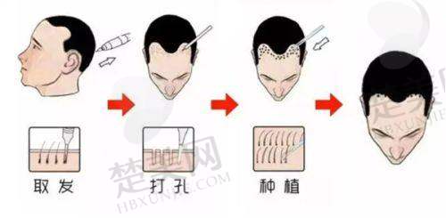 植发相关项目价格参考