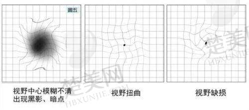 四、邯郸爱尔眼科医院特色项目