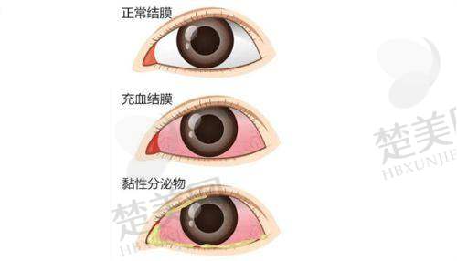 六、深圳普瑞眼科医院价格表