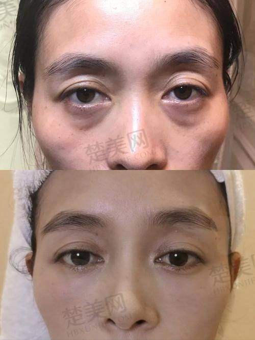 四、禾常青无痕去眼袋价格：物有所值的选择