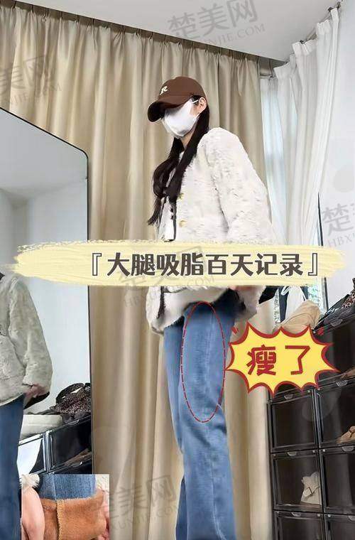四、成都米兰柏羽整形医院吸脂优势