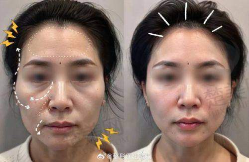 三、选择注射美容医生的注意事项