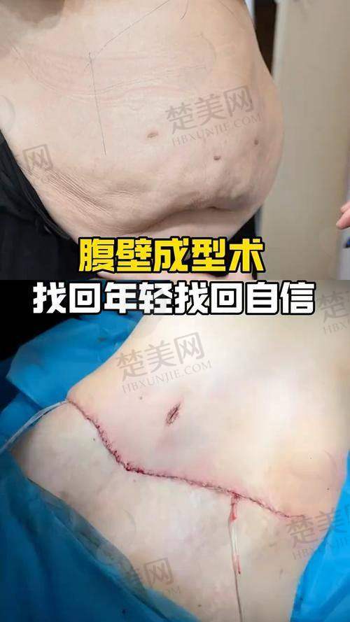 四、北京华韩医疗美容医院：认证医院的成熟腹壁成形项目