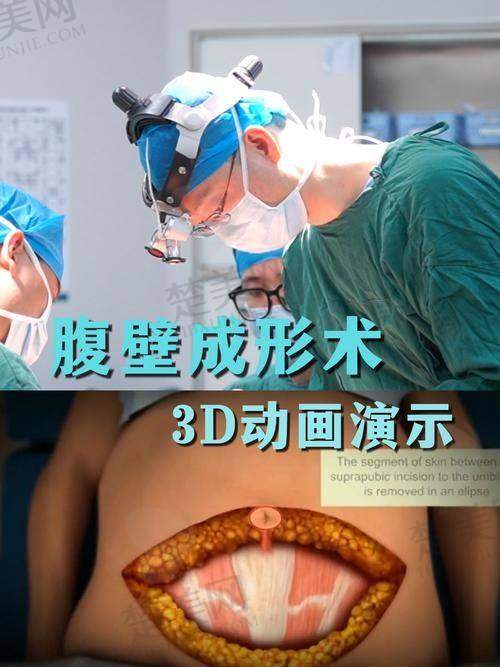 五、北京腹壁成形术大概费用：心中有数不花冤枉钱