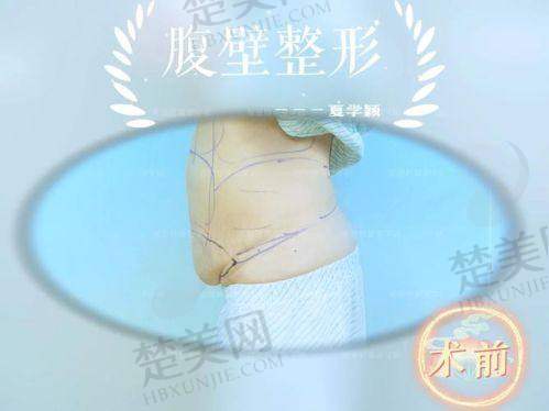 三、北京联合丽格：高难度整形的腹壁成形骨干医生