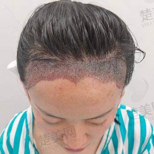 八、成都首瑞植发·专注女性毛发移植——女性专属的贴心之选