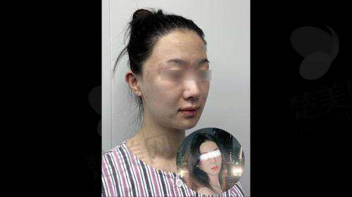 三、西安王汉峰医生吸脂技术优势