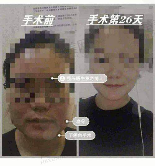 三、不同磨骨项目技术细节