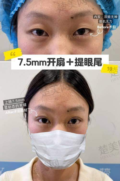 五、张安利医生双眼皮修复价格