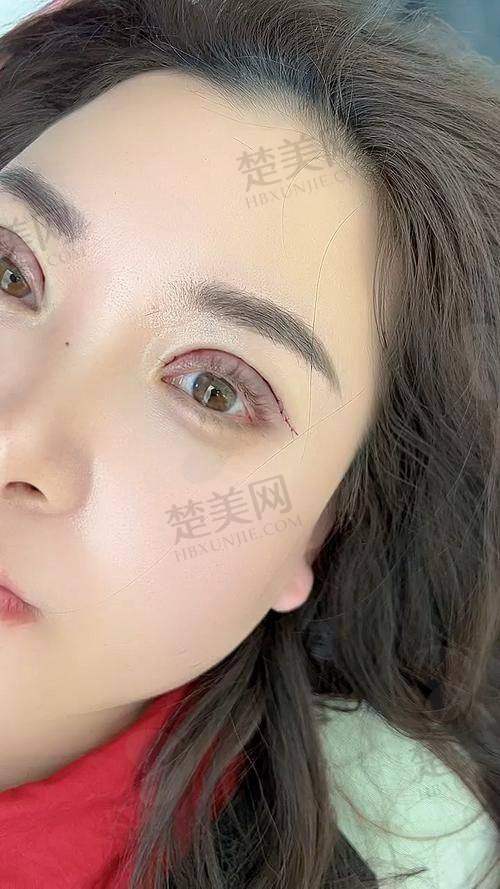 三、张安利医生双眼皮修复实际实例