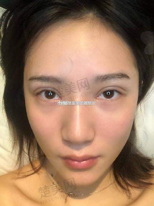 二、张安利医生双眼皮修复技术优势