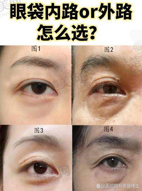 三、上海祛眼袋医生排名榜之丁伟医生