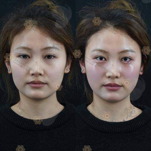 1. 长效抗衰，维持时间3 - 5年