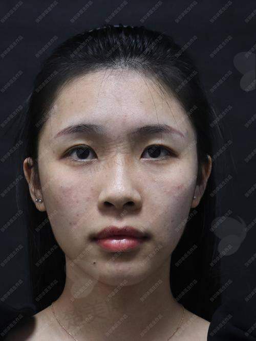 四、成都杨迪医生眼周筋膜提升维持时间