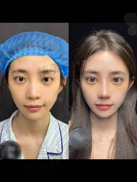 五、关于成都无痕筋膜提升的常见疑问解答
