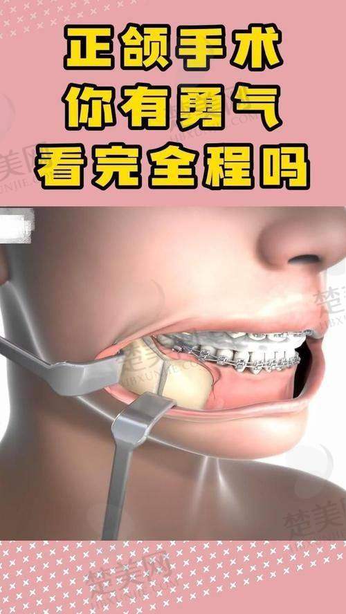 三、吴训医生正颌手术的实际实例及患者口碑
