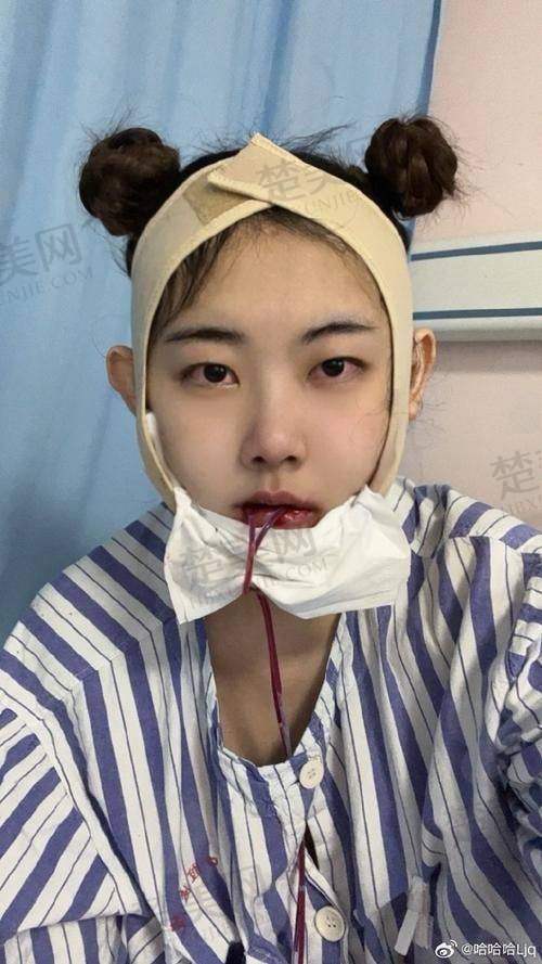 五、正颌手术的风险及吴训医生的应对措施