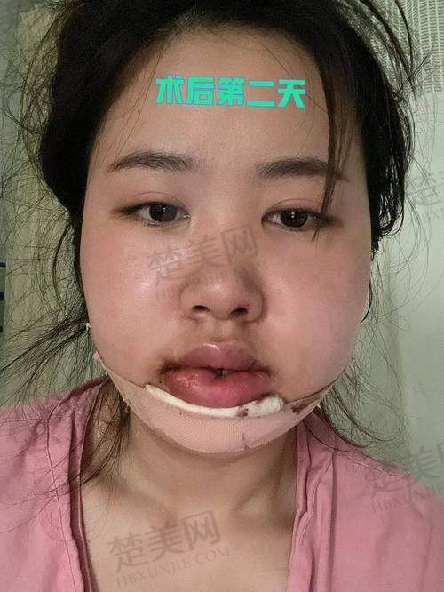 二、吴训医生擅长的正颌技术