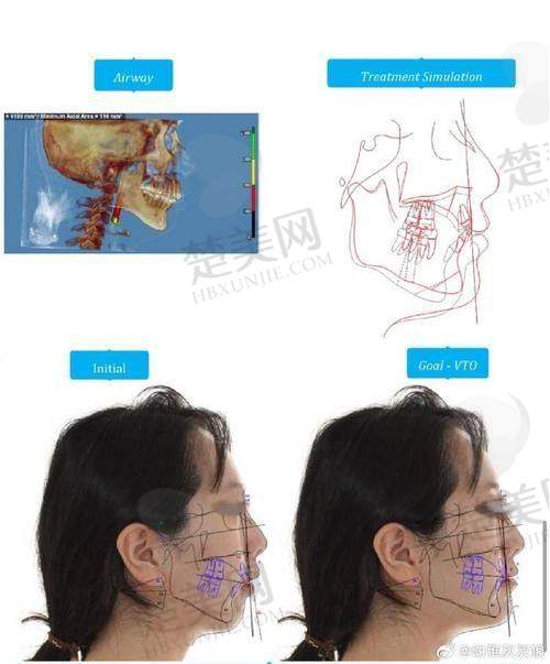 三、广州紫馨整形外科医院——四级正颌手术资质保护