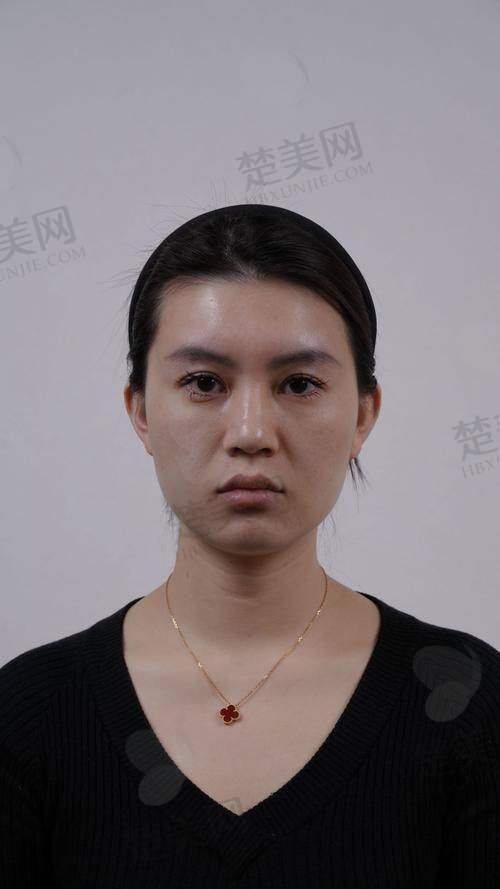 三、玻尿酸去除法令纹的价格范围