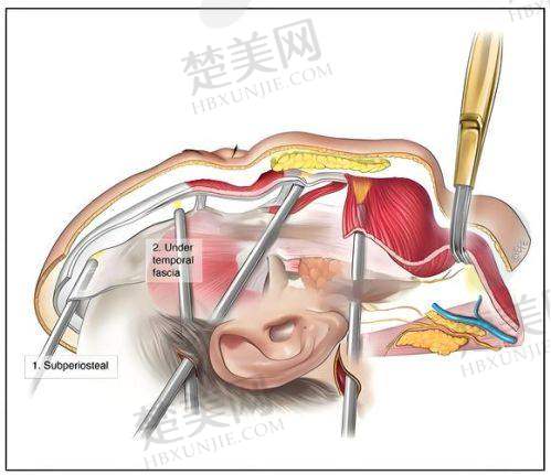 五、北医三院谢宏彬拉皮手术口碑与反馈