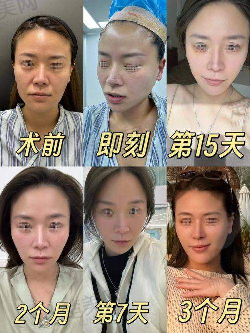 四、如何选择适合自己的医院和手术