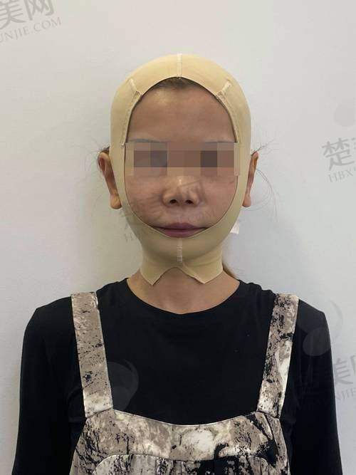 三、袁强博士拉皮手术价格是多少