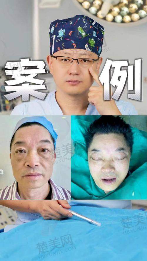 二、袁强博士拉皮手术技术怎么样