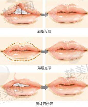 3. 三期手术