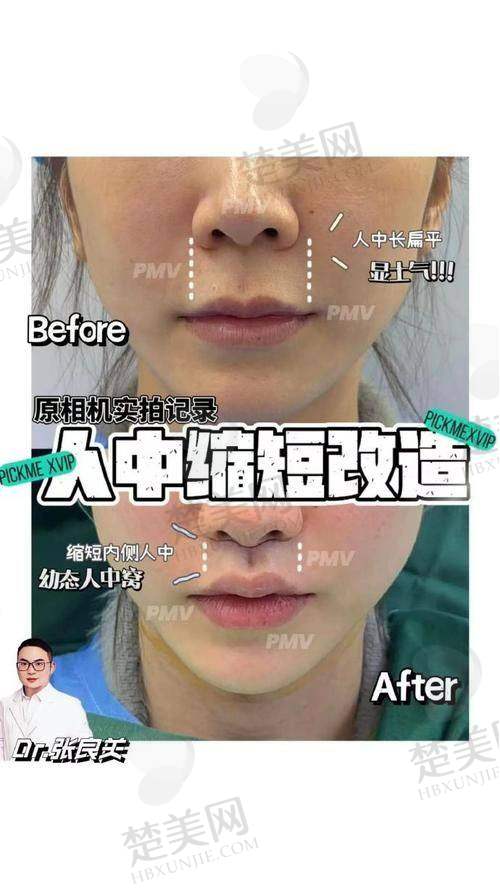 四、广东省人民医院赵成利医生：严谨细致精细控制人中形态