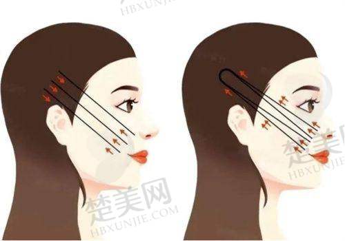 二、刘远程筋膜提升技术原理