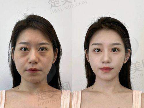 五、刘远程医生——成都素美医疗美容医院的实力派无痕筋膜提升医师