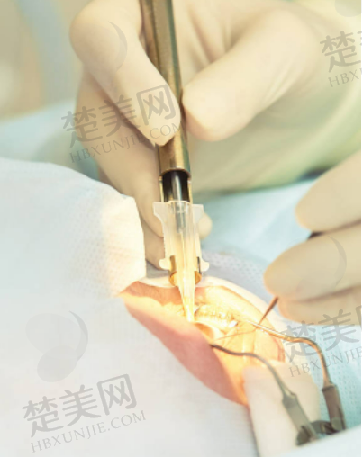 二、北京茗视光眼科全飞秒手术的亲身经历