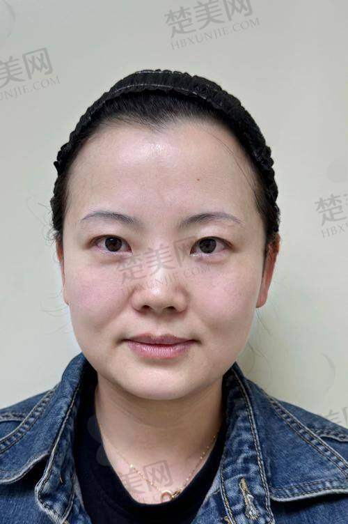 五、绍兴市上虞人民医院——绍兴耳软骨隆鼻哪里好一点的老牌之选