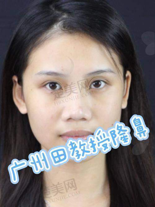 三、罗志敏医生手术价格