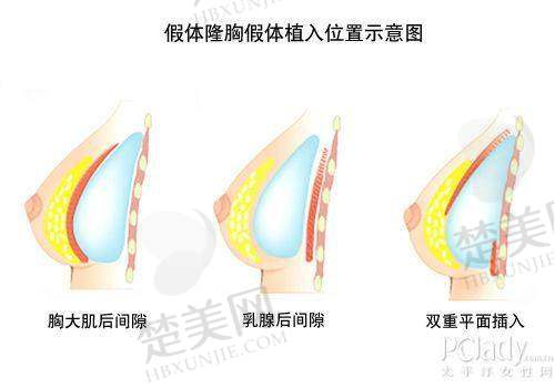 四、胸部奥美定取出哪家医院好？优质医院推荐
