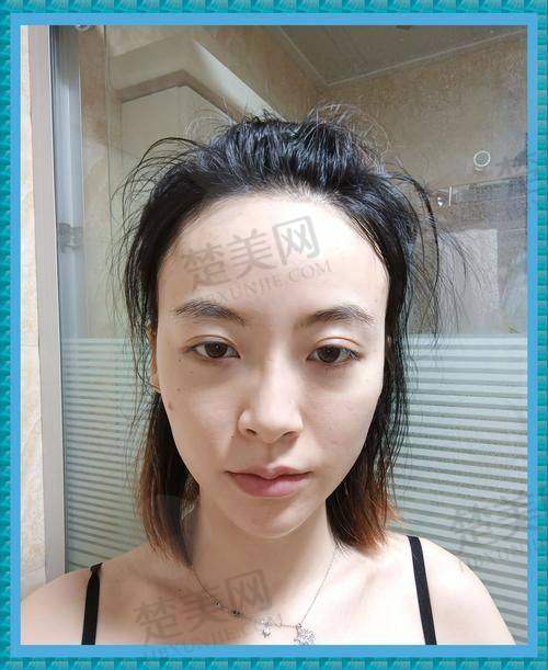 六、不同场景下鼻子整形玻尿酸价格的参考情况