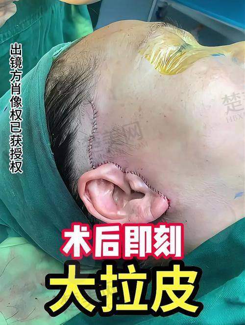三、黄金龙医生拉皮手术实例分享