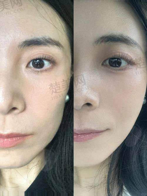 二、深圳热玛吉全脸价格多少钱一次之影响价格的因素