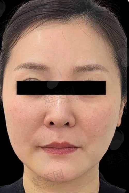 一、深圳热玛吉全脸价格多少钱一次之热玛吉全解析
