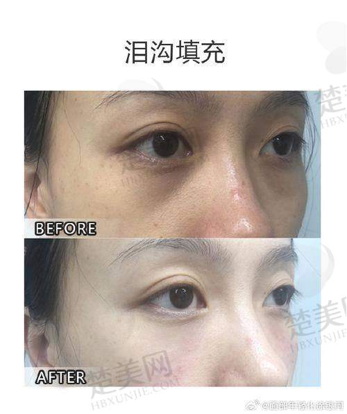 二、激光治疗怎么样消除泪沟