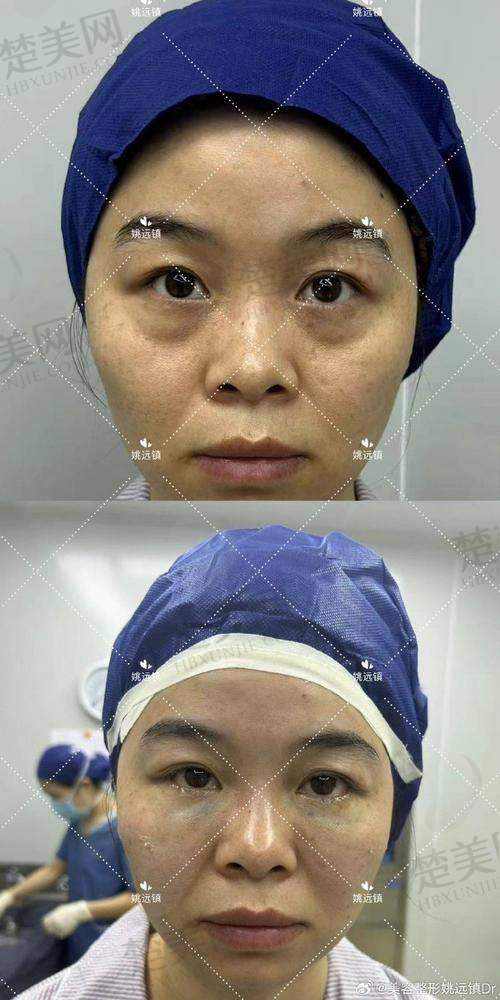 五、选择消除泪沟方法的注意事项