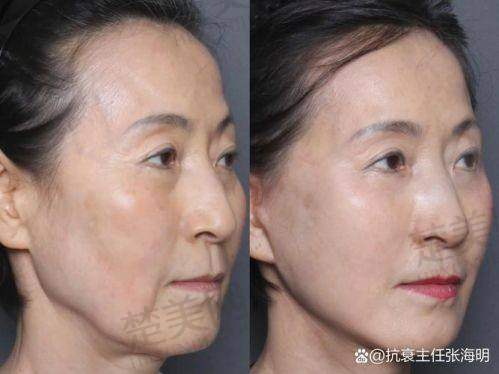 四、杨迪医生——成都素美整形医院的眼部筋膜提升骨干医生