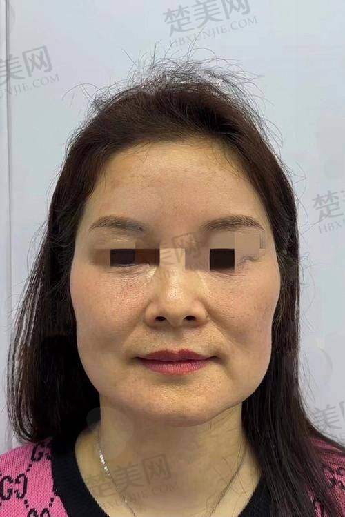 三、蒲兴旺医生——成都懿和唯美医疗美容医院的小切口拉皮高手
