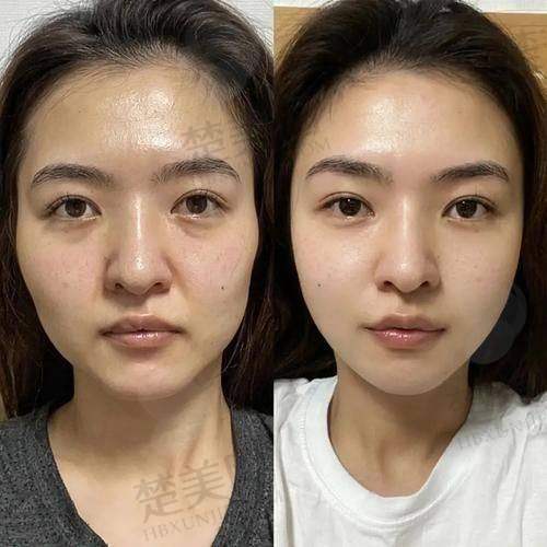 四、眼周筋膜悬吊手术优势展示