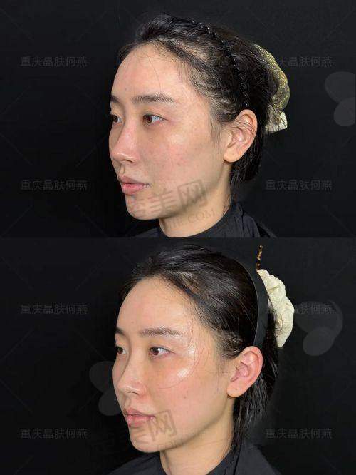 五、手术适合人群与注意事项