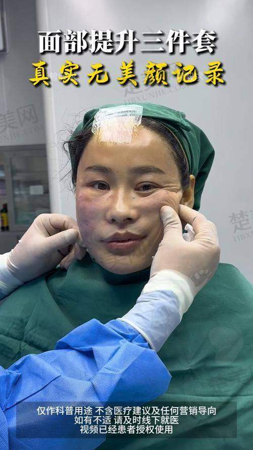 六、刘远程筋膜提升口碑评价