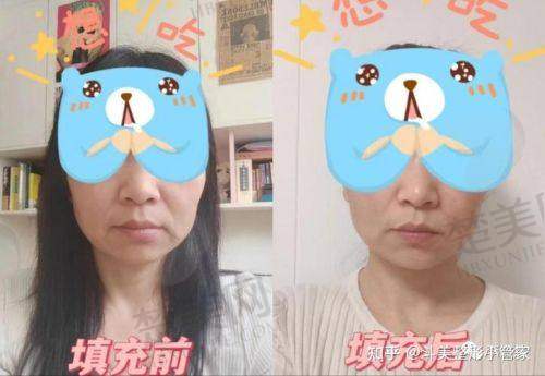 五、自体脂肪祛法令纹的术前注意事项