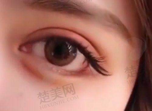 三、曾繁茂双眼皮手术优势数据说话
